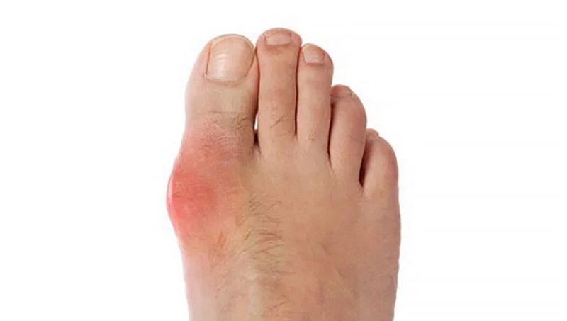 Close-up of a foot with redness and swelling around the big toe joint, suggesting an inflamed bunion; clinical, medical tone.